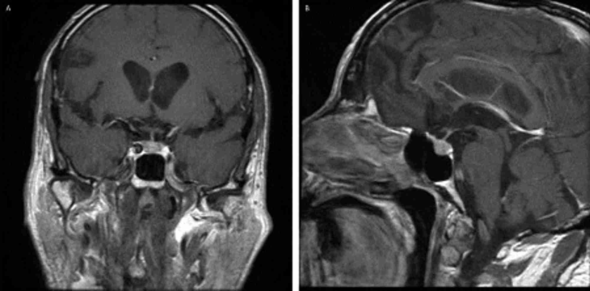 Figure. T1–weighted MRI with gadolinium in the same patient as described in the Table demonstrated a modest diffuse enlargement of the pituitary gland for his age, with some heterogeneity of contrast enhancement across the gland, consistent with hypophysitis.