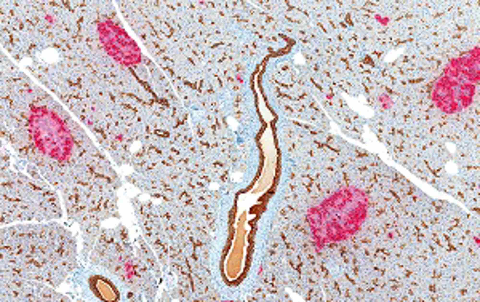 Pancreas showing multiple islets of Langerhans containing b-cells stained immunohistochemically for insulin (red) with ducts stained for cytokeratin (brown). Credit: Shutterstock