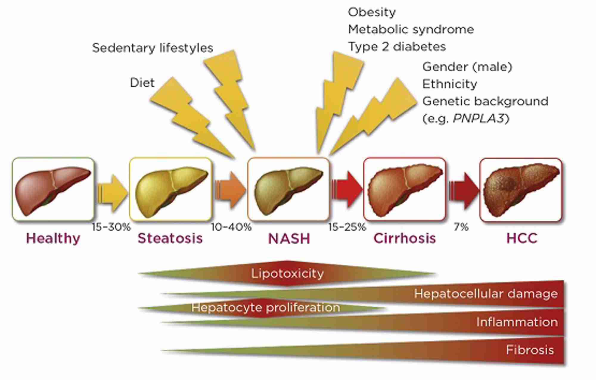 Stages and pathophysiology of NASH (HCC, hepatocellular carcinoma). &#169;M. Allison &amp; M. Vacca