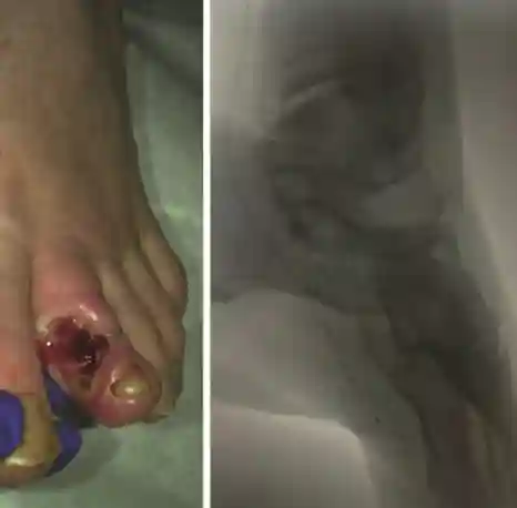 Figure 2. Left pedal artery loop angioplasty in a patient with second toe osteomyelitis. &#169;KingsDFC