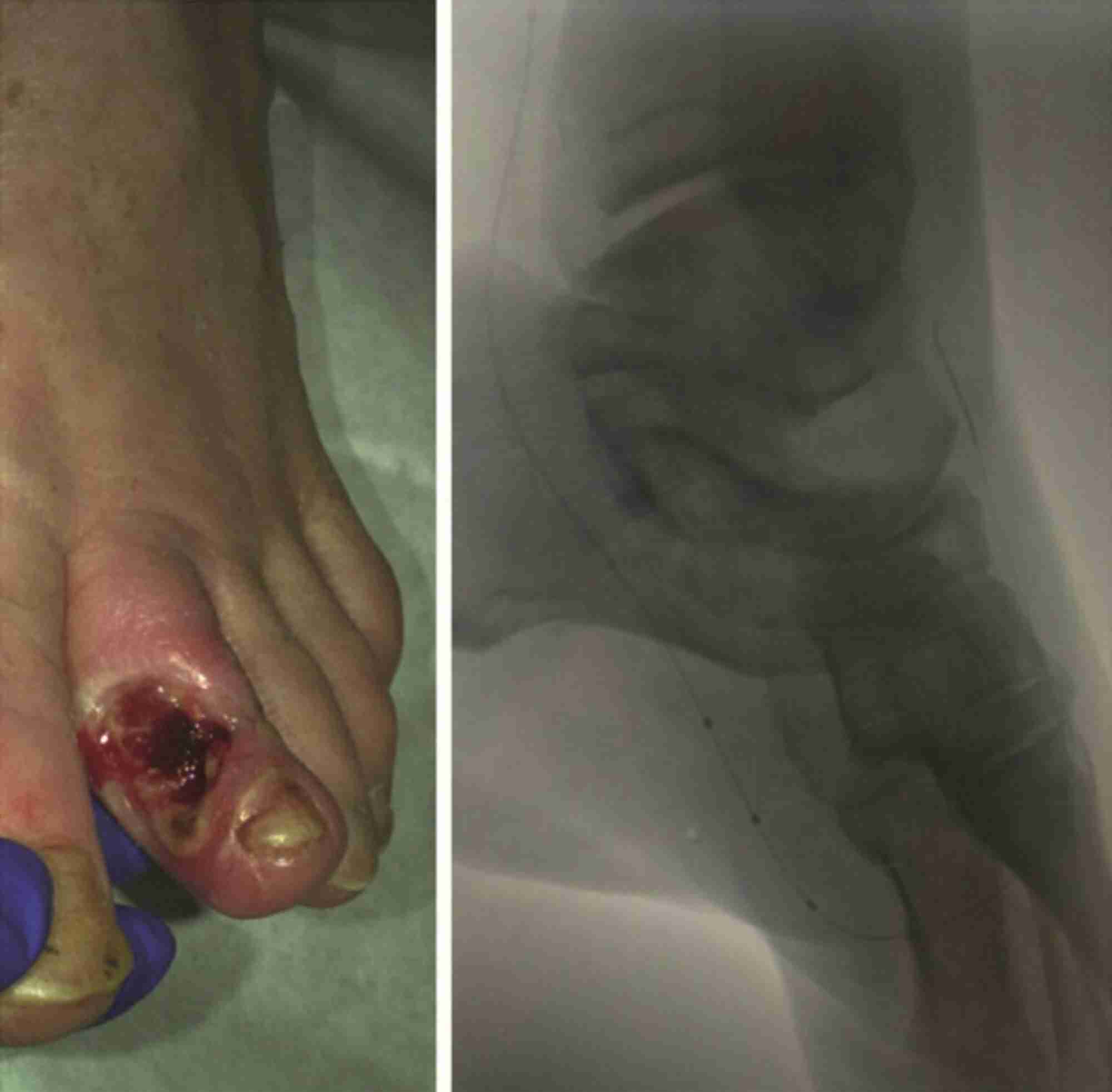 Figure 2. Left pedal artery loop angioplasty in a patient with second toe osteomyelitis. &#169;KingsDFC