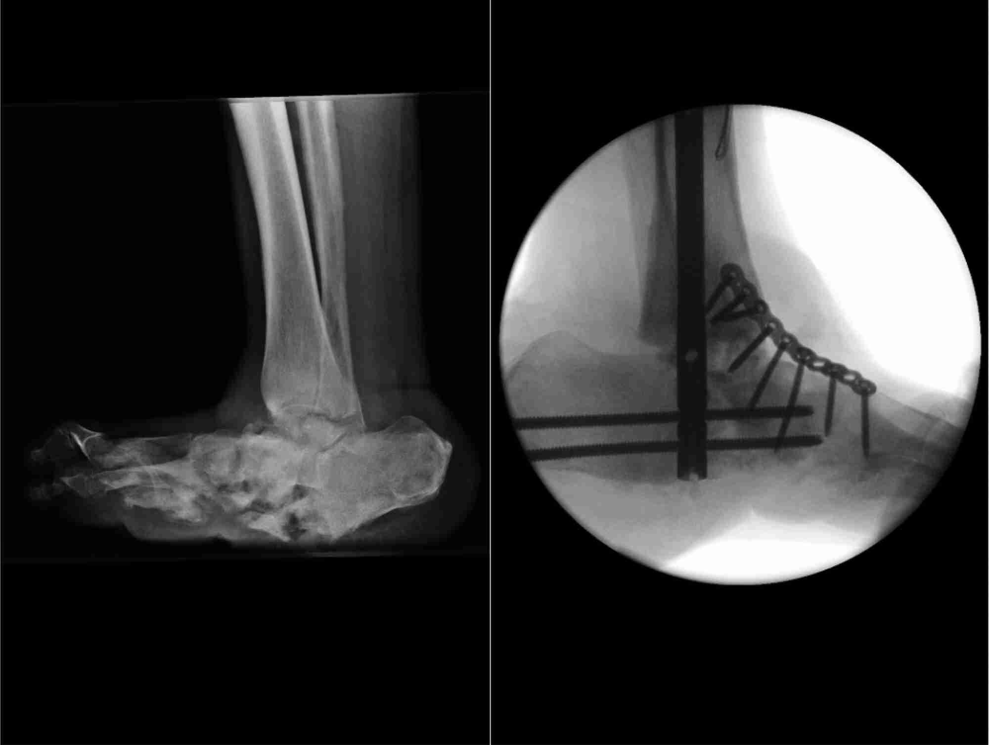 Figure 4. Left foot hind-foot and mid-foot reconstruction (right panel) for severe Charcot deformity (left panel). L, left; W/T, weight. &#169;KingsDFC