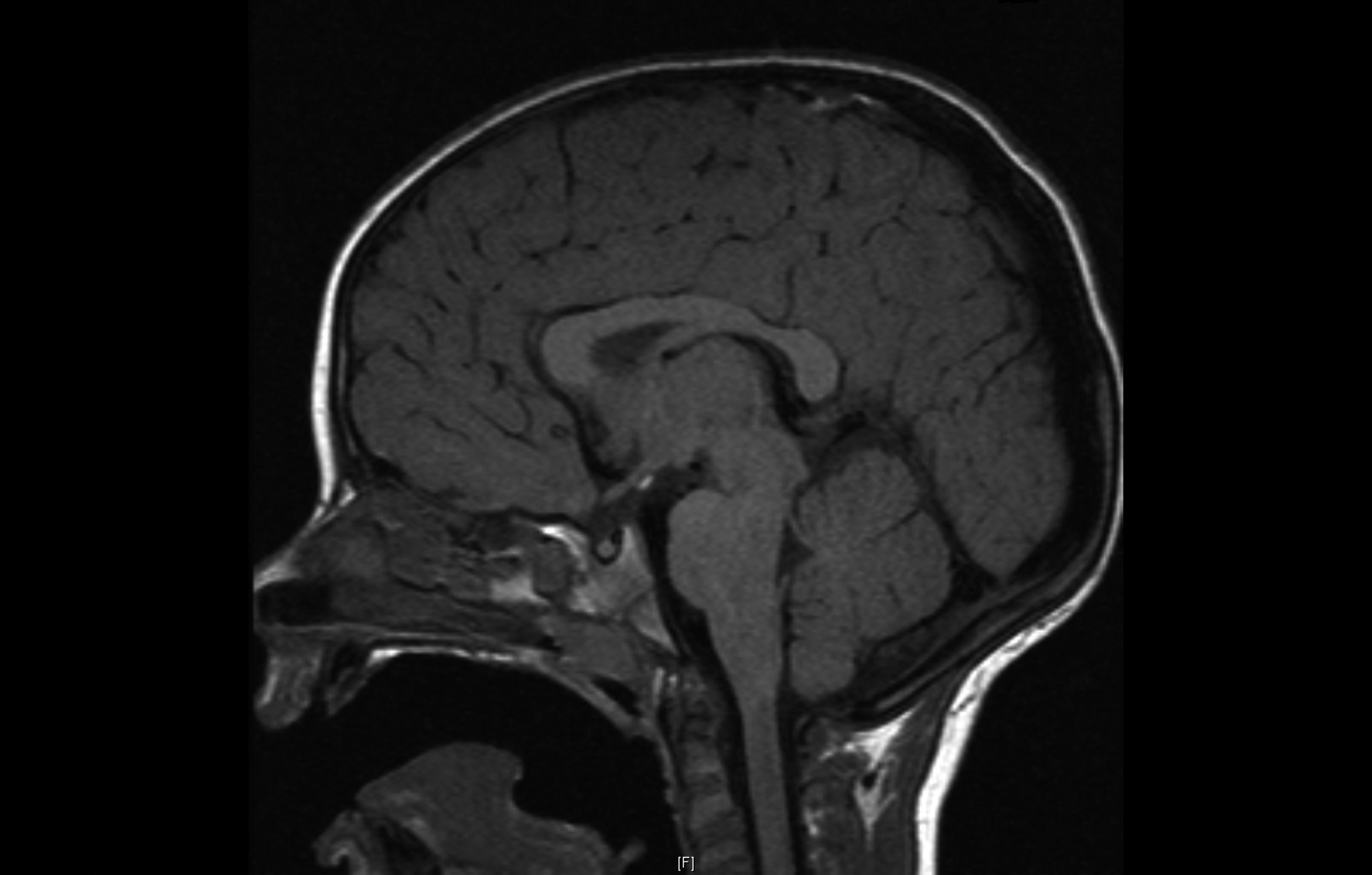 Ectopic posterior pituitary (PP) with anterior pituitary (AP)  hypoplasia. Pituitary stalk (PS) is absent in this image. &#169;Mehul Dattani