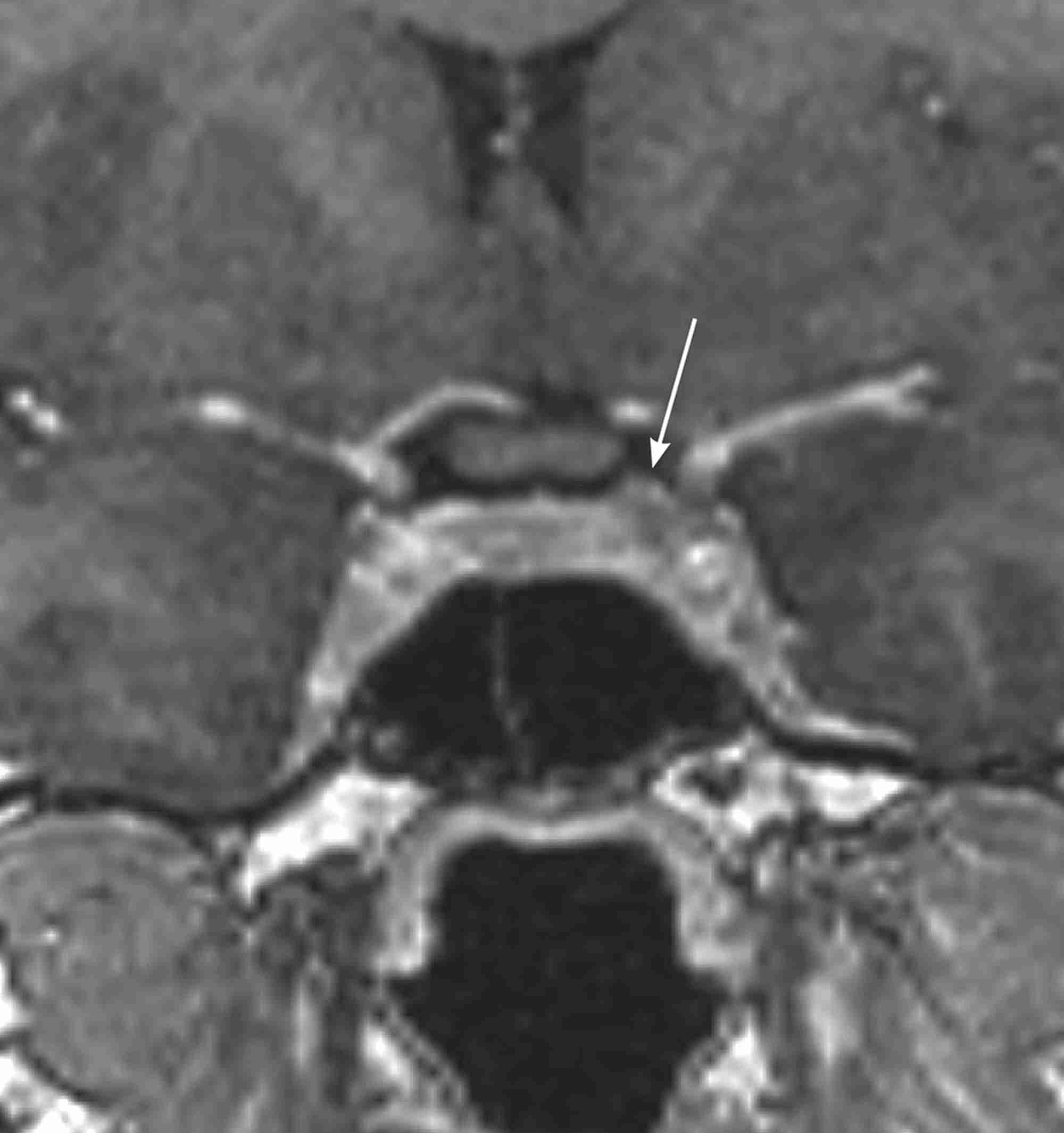 MRI scan of a microprolactinoma